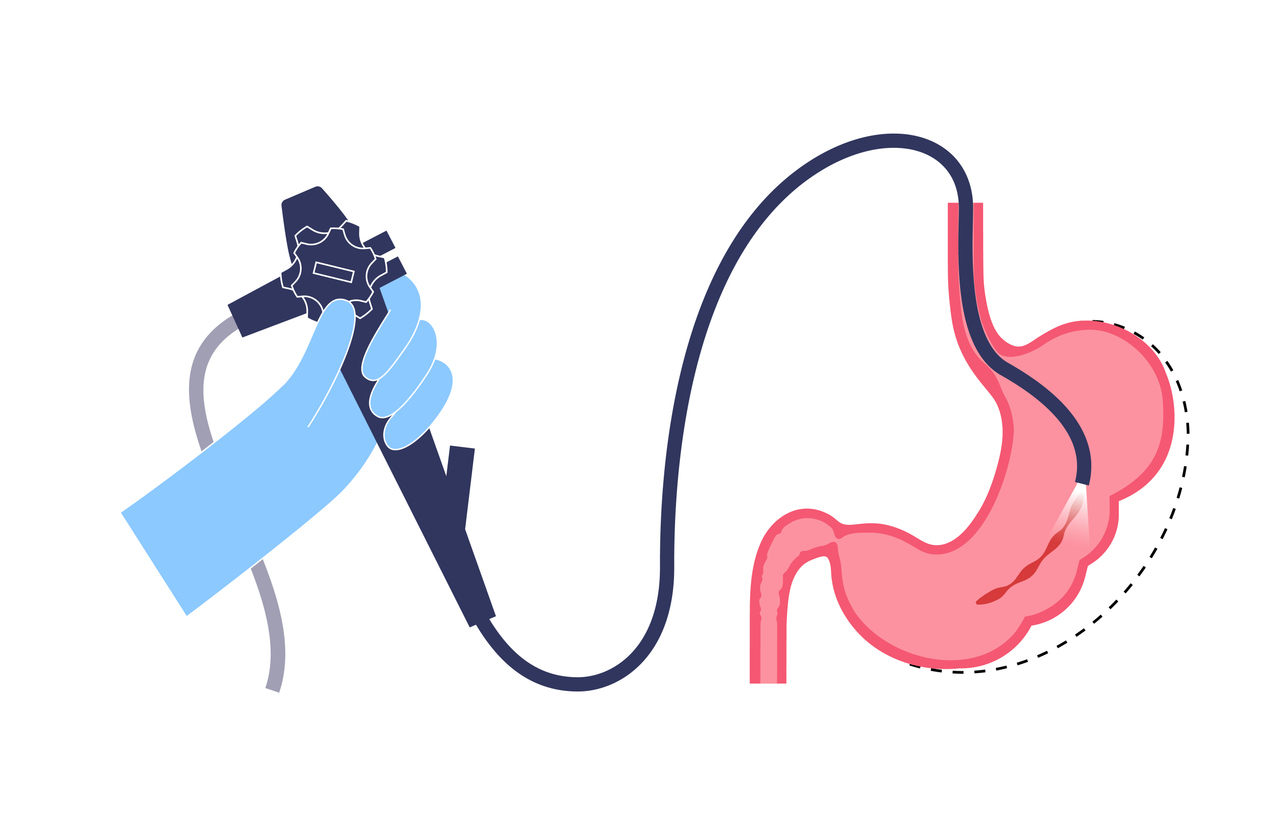 Gastroplastie endoscopique à manchon